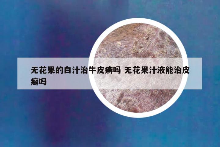 无花果的白汁治牛皮癣吗 无花果汁液能治皮癣吗