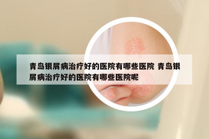 青岛银屑病治疗好的医院有哪些医院 青岛银屑病治疗好的医院有哪些医院呢