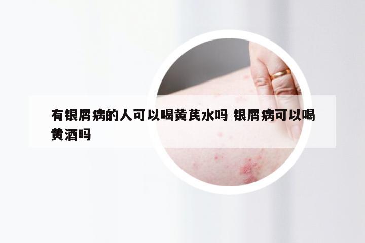 有银屑病的人可以喝黄芪水吗 银屑病可以喝黄酒吗