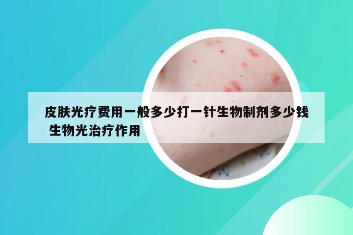皮肤光疗费用一般多少打一针生物制剂多少钱 生物光治疗作用