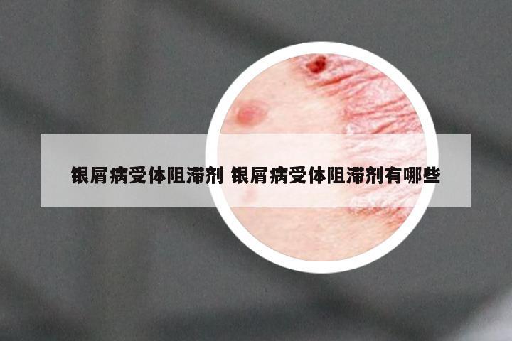 银屑病受体阻滞剂 银屑病受体阻滞剂有哪些