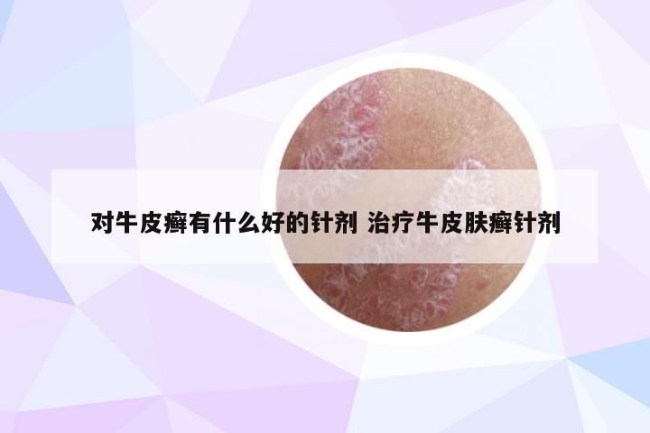 对牛皮癣有什么好的针剂 治疗牛皮肤癣针剂