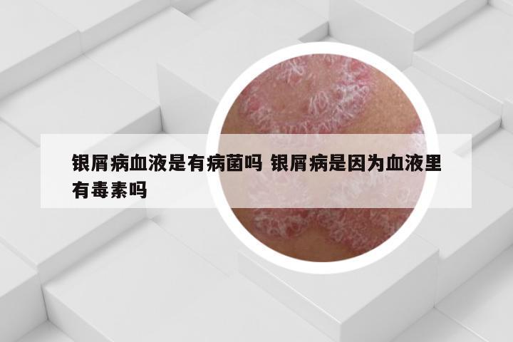 银屑病血液是有病菌吗 银屑病是因为血液里有毒素吗