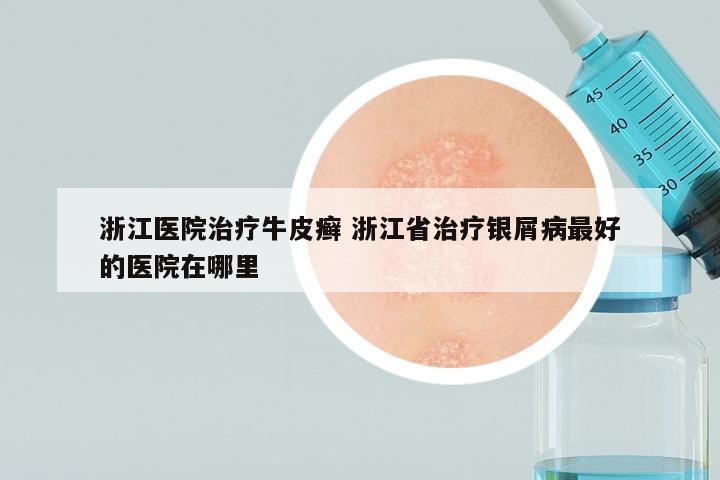 浙江医院治疗牛皮癣 浙江省治疗银屑病最好的医院在哪里