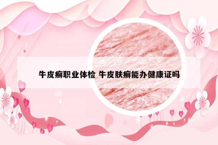 牛皮癣职业体检 牛皮肤癣能办健康证吗