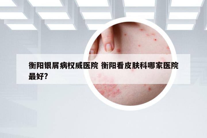 衡阳银屑病权威医院 衡阳看皮肤科哪家医院最好?