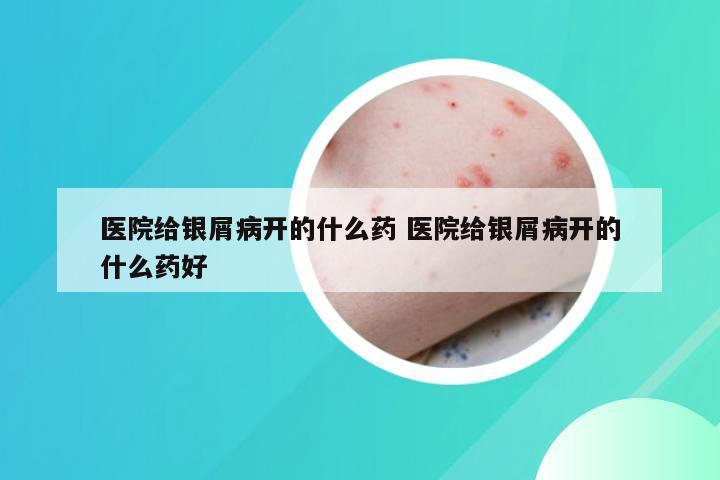 医院给银屑病开的什么药 医院给银屑病开的什么药好
