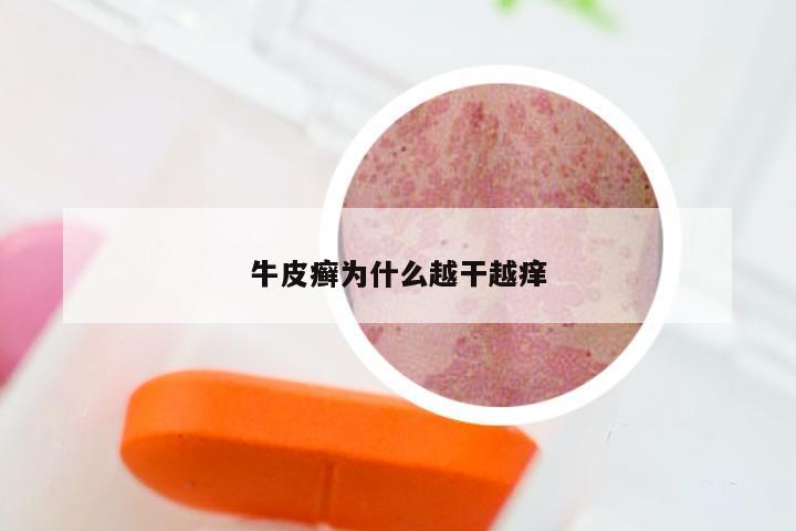 牛皮癣为什么越干越痒