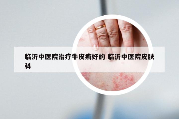 临沂中医院治疗牛皮癣好的 临沂中医院皮肤科