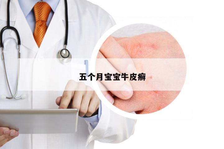 五个月宝宝牛皮癣