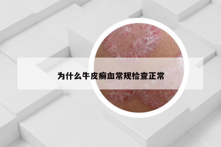为什么牛皮癣血常规检查正常