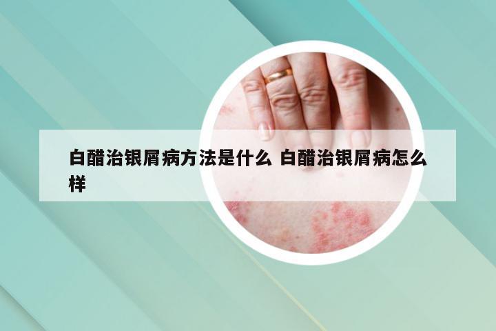 白醋治银屑病方法是什么 白醋治银屑病怎么样