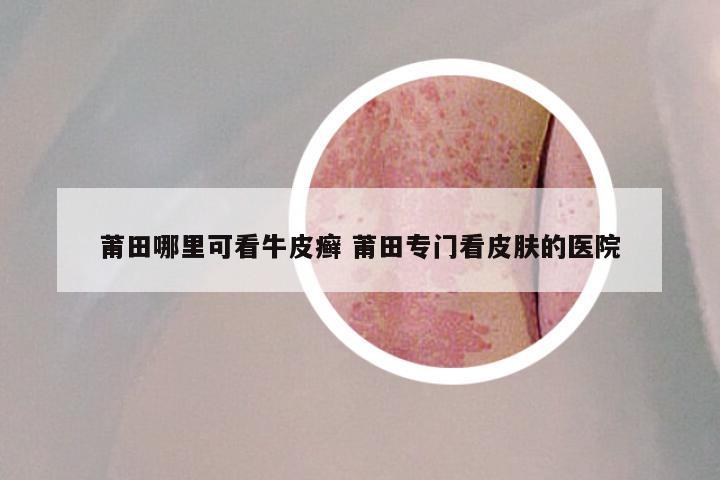 莆田哪里可看牛皮癣 莆田专门看皮肤的医院