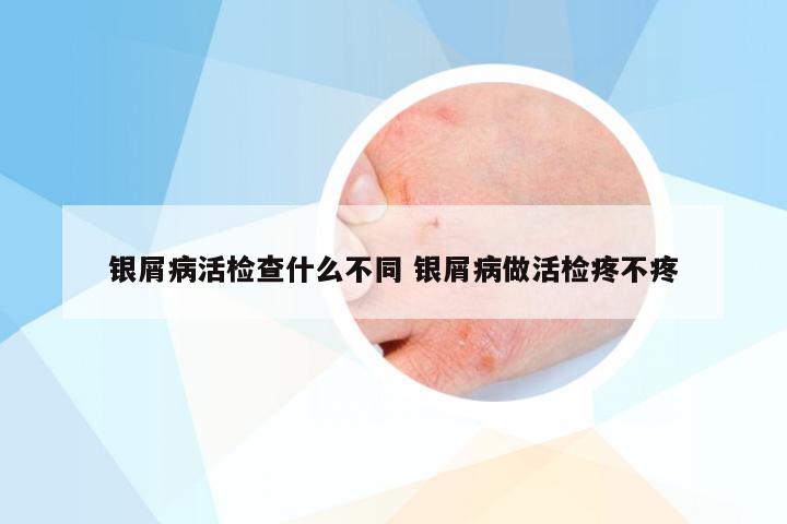 银屑病活检查什么不同 银屑病做活检疼不疼
