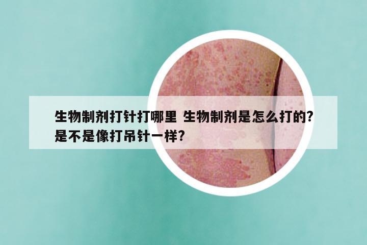 生物制剂打针打哪里 生物制剂是怎么打的?是不是像打吊针一样?