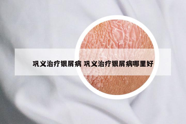 巩义治疗银屑病 巩义治疗银屑病哪里好