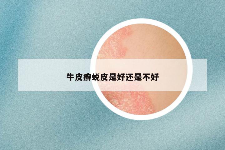 牛皮癣蜕皮是好还是不好