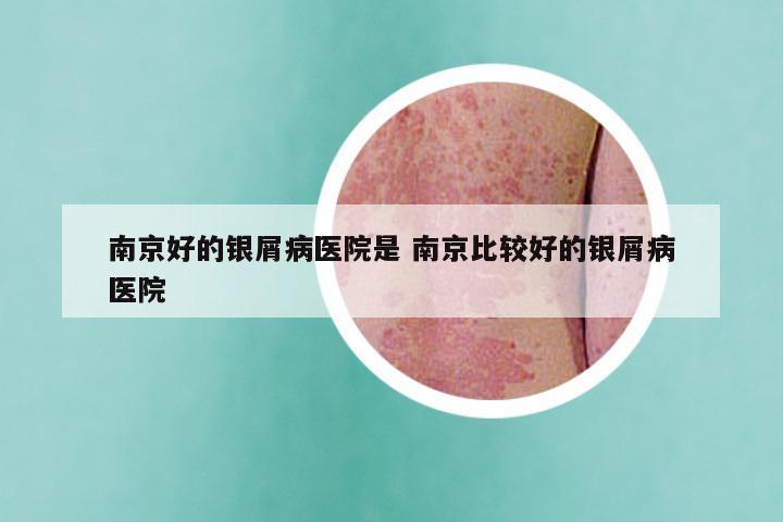 南京好的银屑病医院是 南京比较好的银屑病医院