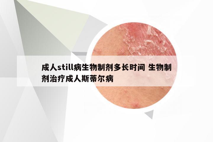 成人still病生物制剂多长时间 生物制剂治疗成人斯蒂尔病