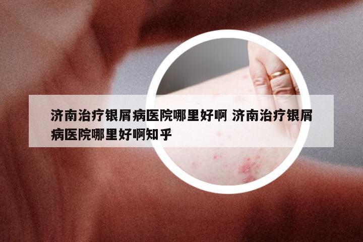 济南治疗银屑病医院哪里好啊 济南治疗银屑病医院哪里好啊知乎
