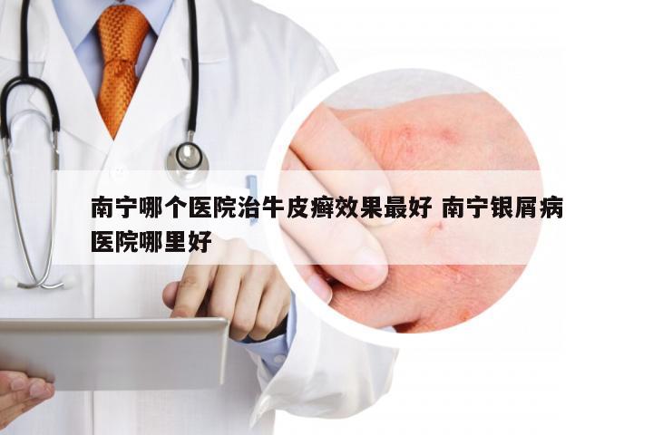 南宁哪个医院治牛皮癣效果最好 南宁银屑病医院哪里好