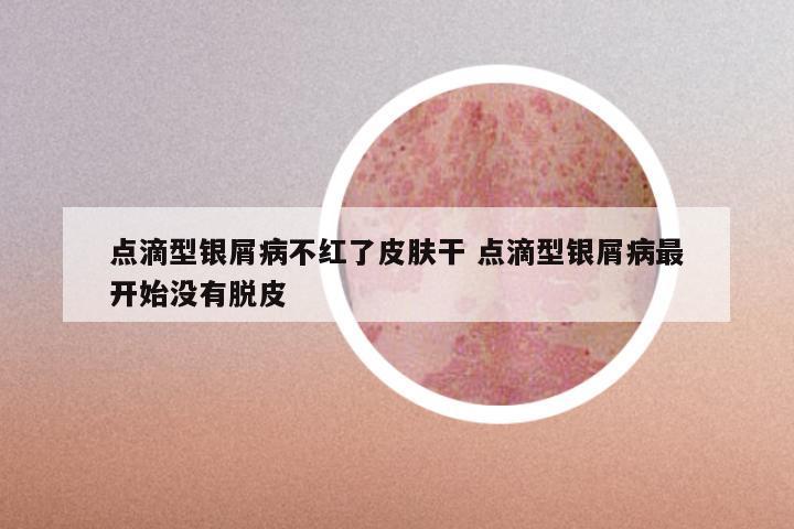 点滴型银屑病不红了皮肤干 点滴型银屑病最开始没有脱皮