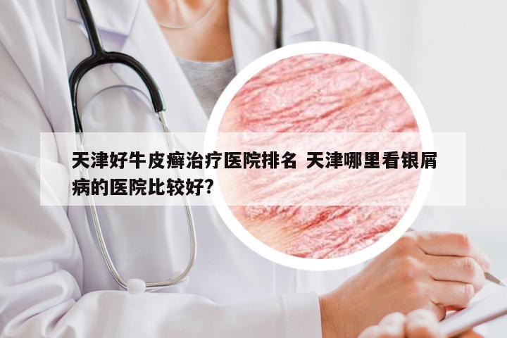 天津好牛皮癣治疗医院排名 天津哪里看银屑病的医院比较好?