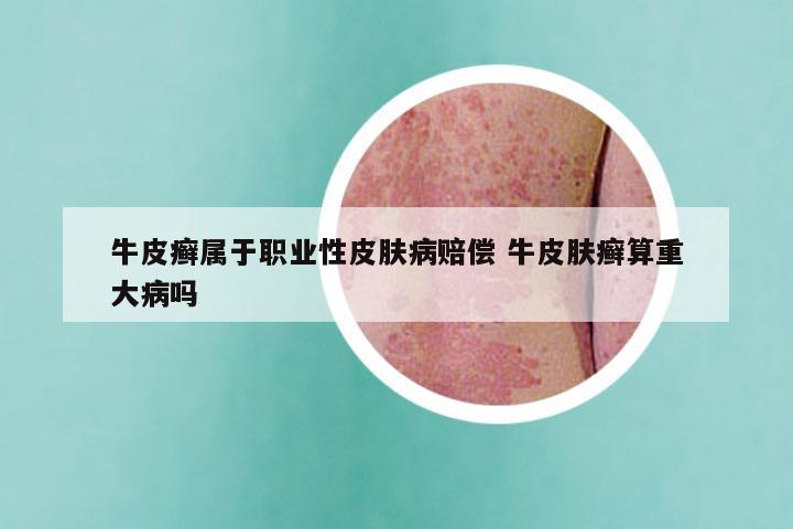 牛皮癣属于职业性皮肤病赔偿 牛皮肤癣算重大病吗