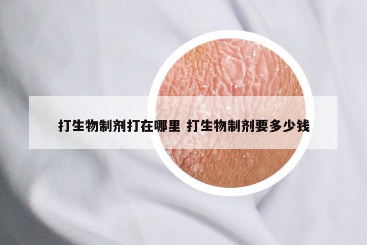 打生物制剂打在哪里 打生物制剂要多少钱