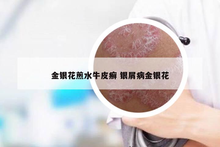 金银花煎水牛皮癣 银屑病金银花