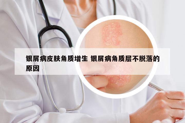 银屑病皮肤角质增生 银屑病角质层不脱落的原因