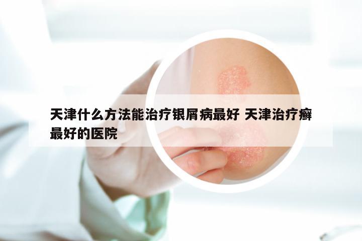 天津什么方法能治疗银屑病最好 天津治疗癣最好的医院