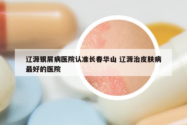辽源银屑病医院认准长春华山 辽源治皮肤病最好的医院