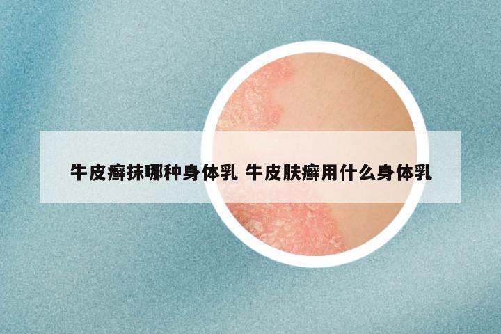牛皮癣抹哪种身体乳 牛皮肤癣用什么身体乳