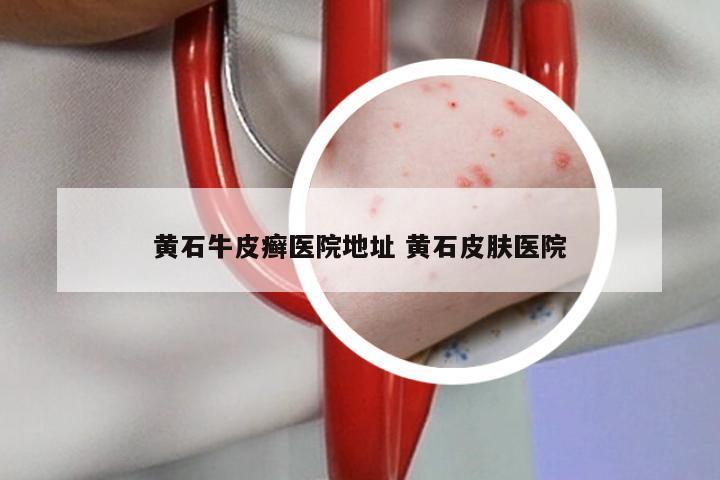 黄石牛皮癣医院地址 黄石皮肤医院
