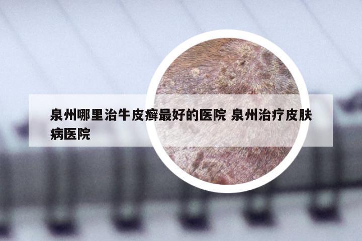泉州哪里治牛皮癣最好的医院 泉州治疗皮肤病医院