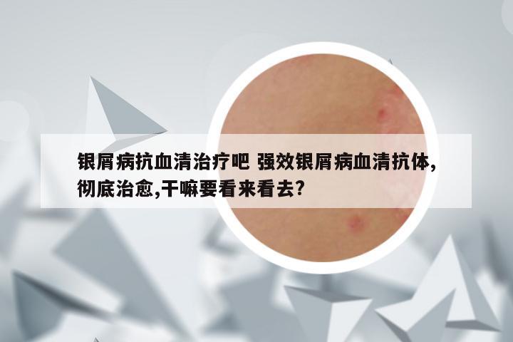 银屑病抗血清治疗吧 强效银屑病血清抗体,彻底治愈,干嘛要看来看去?