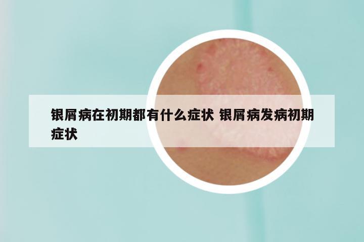 银屑病在初期都有什么症状 银屑病发病初期症状