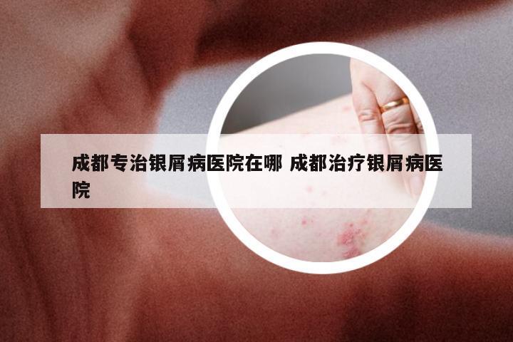 成都专治银屑病医院在哪 成都治疗银屑病医院