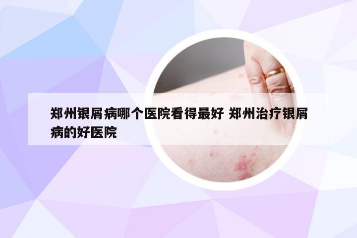 郑州银屑病哪个医院看得最好 郑州治疗银屑病的好医院