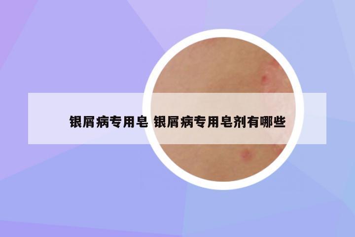 银屑病专用皂 银屑病专用皂剂有哪些
