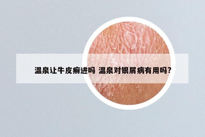 温泉让牛皮癣进吗 温泉对银屑病有用吗?