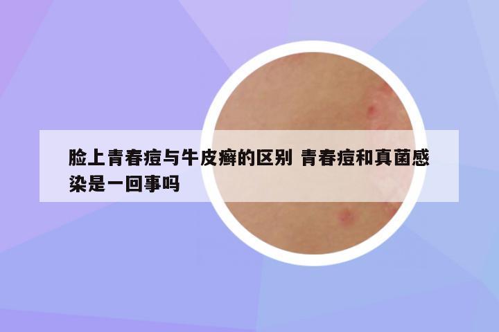 脸上青春痘与牛皮癣的区别 青春痘和真菌感染是一回事吗