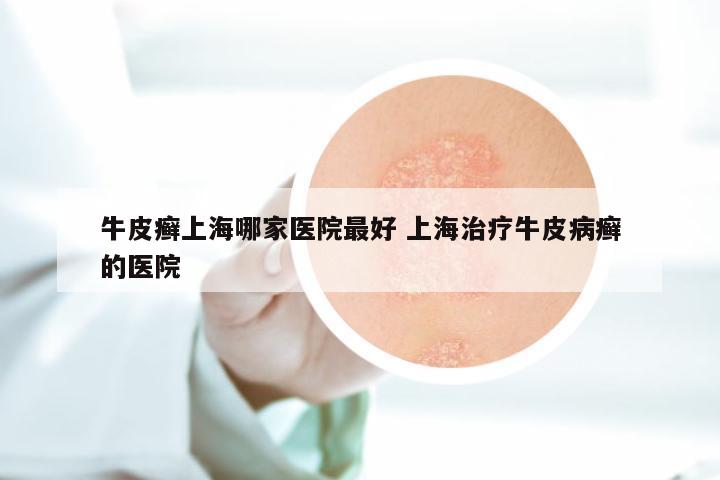 牛皮癣上海哪家医院最好 上海治疗牛皮病癣的医院