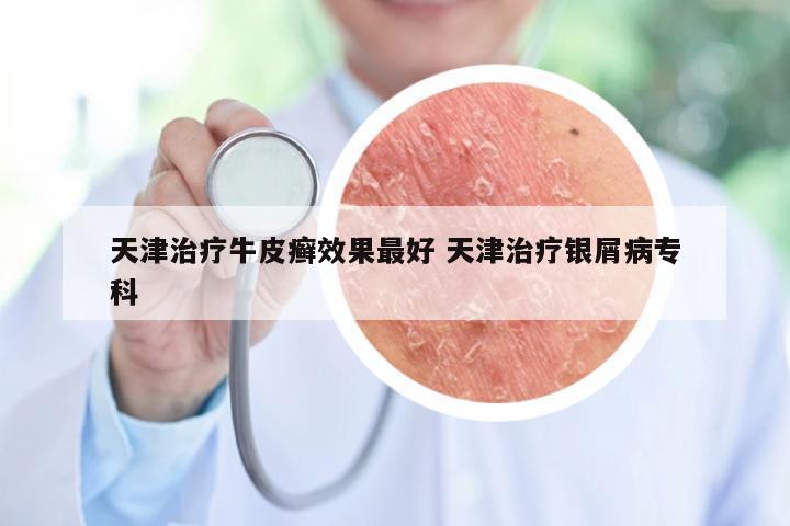 天津治疗牛皮癣效果最好 天津治疗银屑病专科