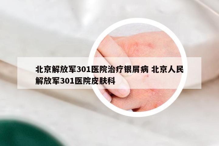北京解放军301医院治疗银屑病 北京人民解放军301医院皮肤科