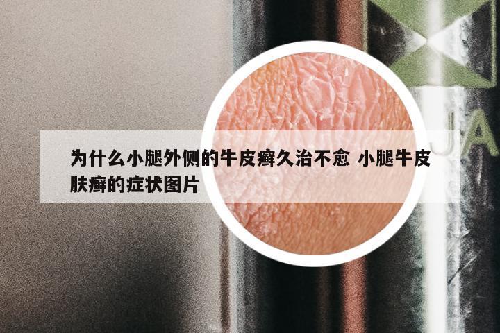 为什么小腿外侧的牛皮癣久治不愈 小腿牛皮肤癣的症状图片