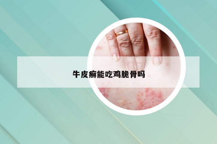 牛皮癣能吃鸡脆骨吗
