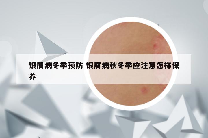 银屑病冬季预防 银屑病秋冬季应注意怎样保养