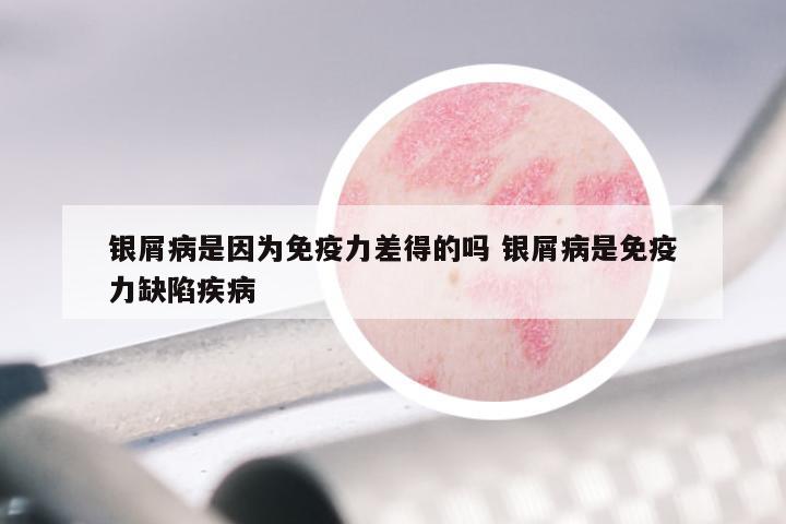 银屑病是因为免疫力差得的吗 银屑病是免疫力缺陷疾病